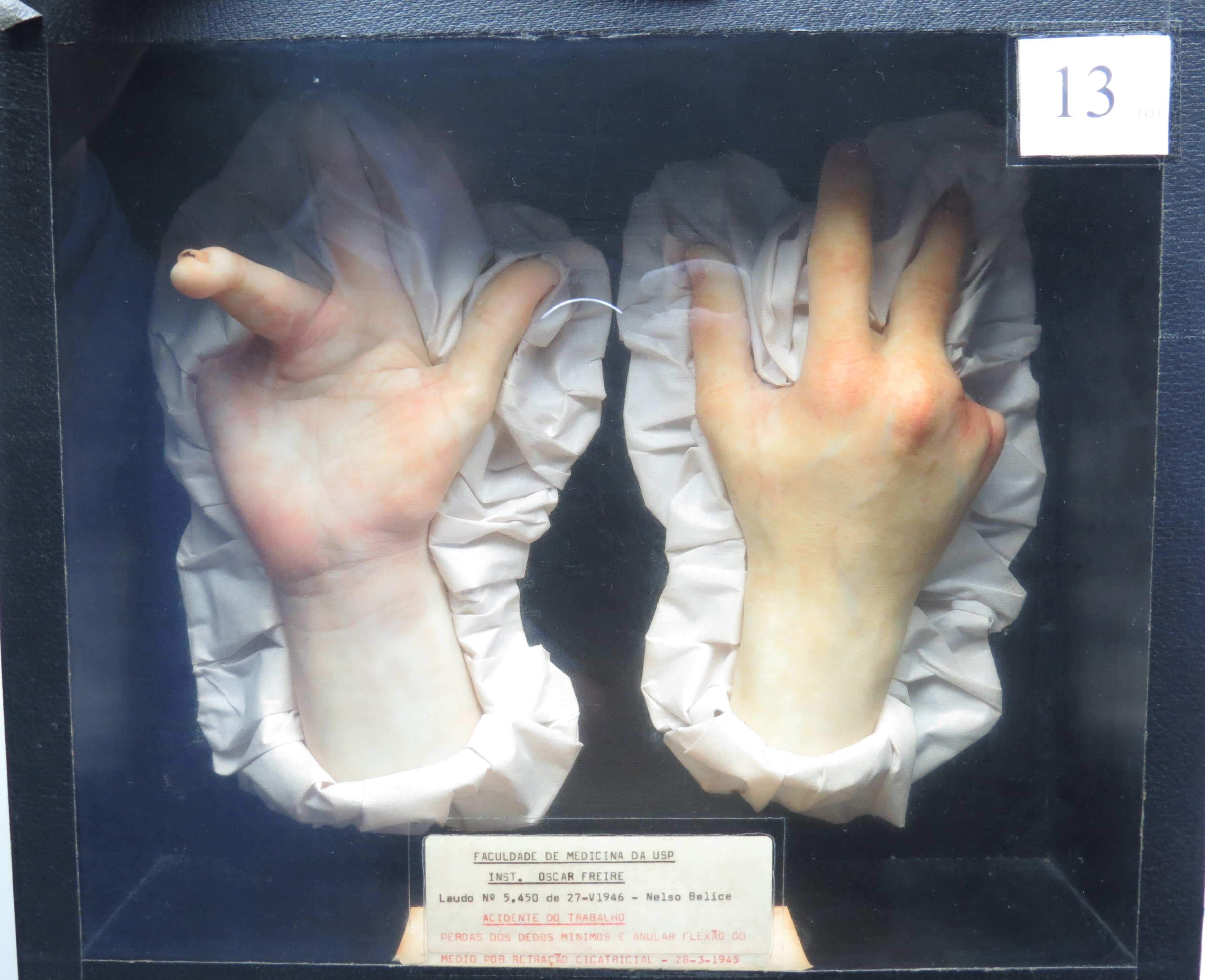 “Escultura de Cera n°13 – Acidente de Trabalho, perda dos dedos mínimo e anular” “Escultura de Cera n°13 – Acidente de Trabalho, perda dos dedos mínimo e anular”