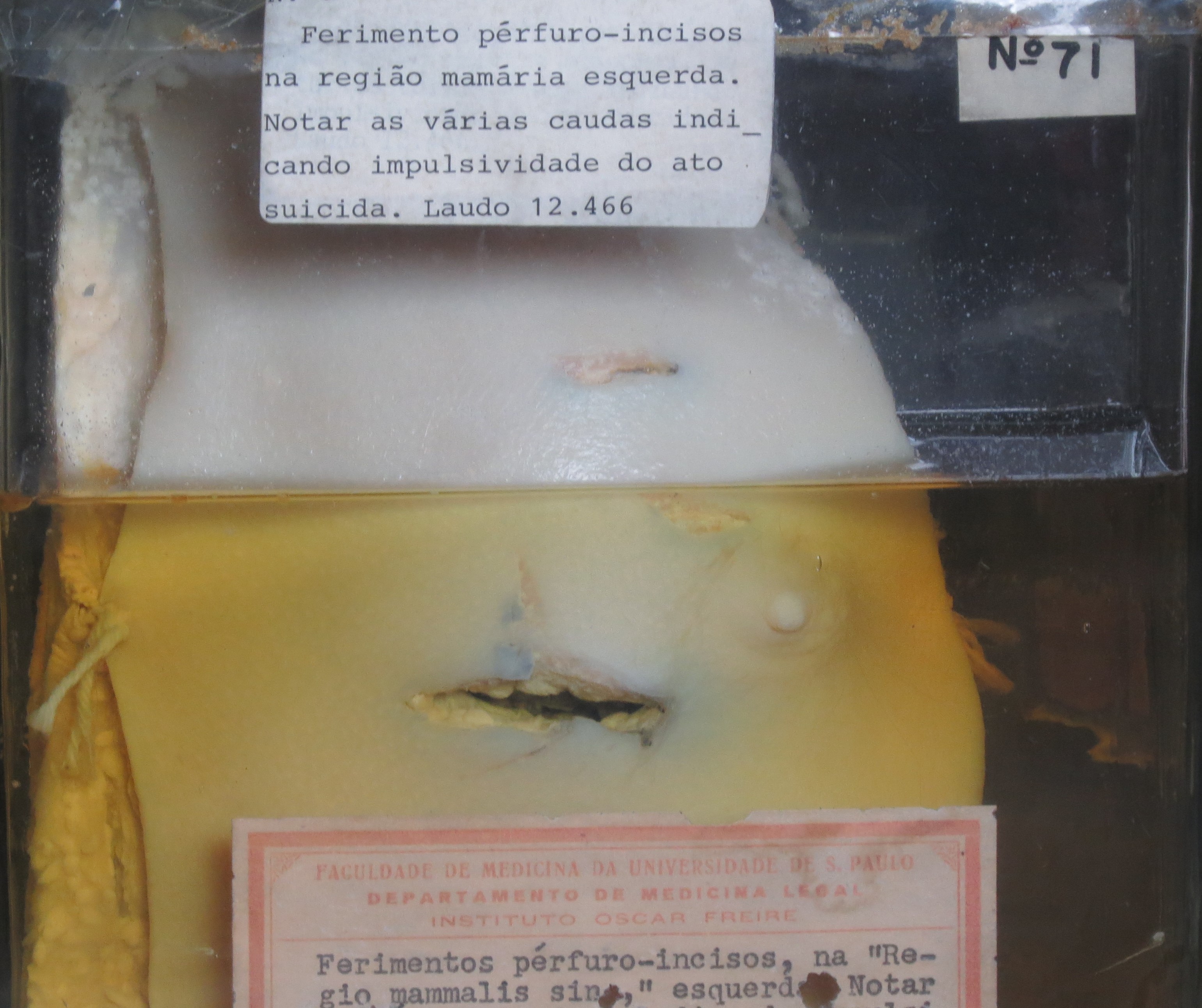 “Peça Orgânica n°71 – Ferimento Pérfuro-incisos” “Peça Orgânica n°71 – Ferimento Pérfuro-incisos”